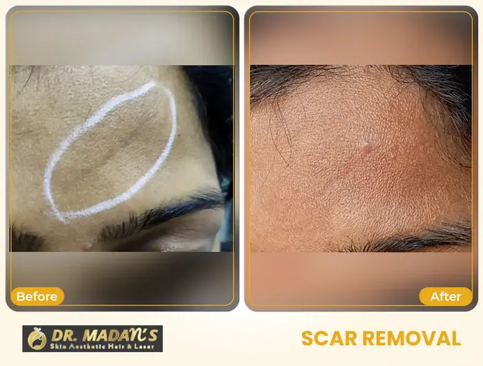 Scar removal before and after result 3 at Dr Madan Aesthetics